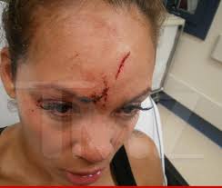 The HeadButt Heard Around The World.  This photo of Evelyn's forehead cut up from Ochocinco allegedly headbutting her after she confronted him bout a used condom.